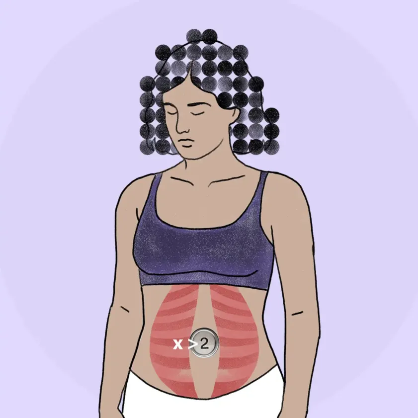 Diástasis abdominal, la condición de quienes han sido mamás
