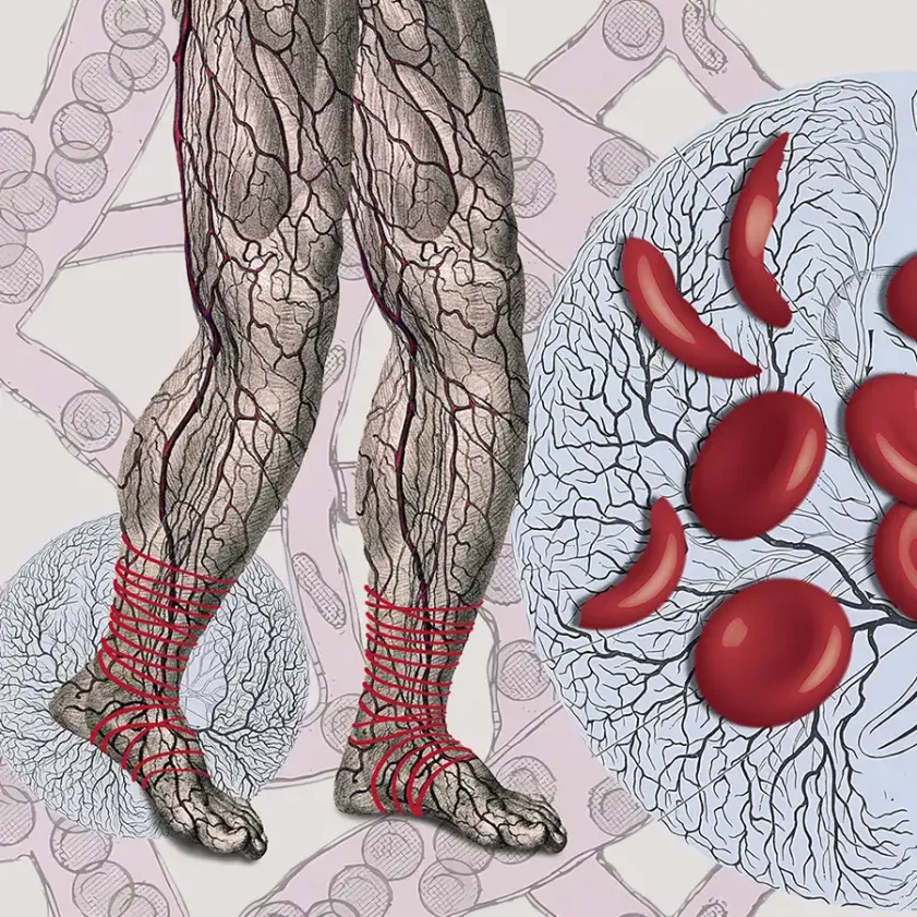 Sobrellevar el dolor cuando se tiene anemia falciforme