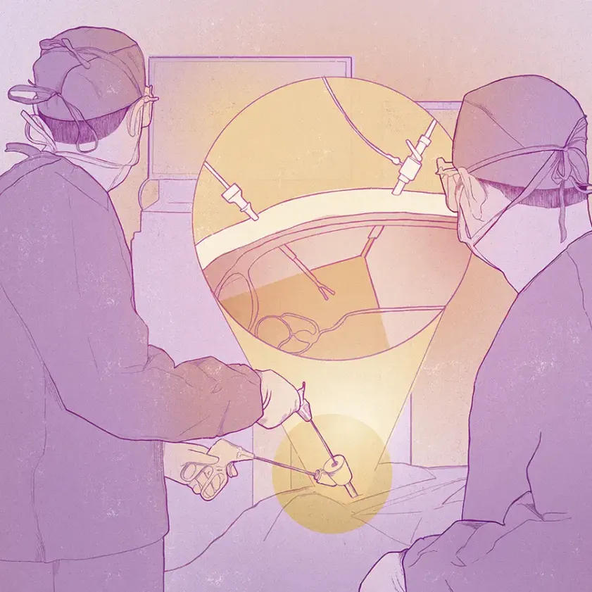 Cirugía laparoscópica: alta precisión y excelentes resultados