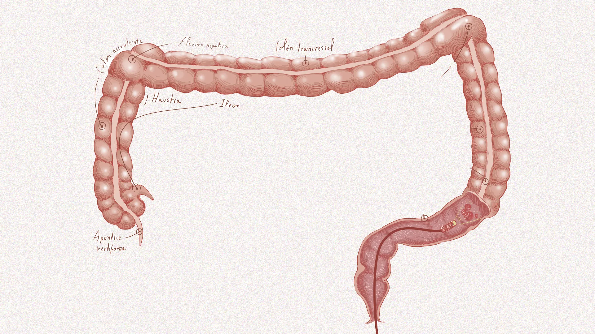 Cuidado con el cáncer de colon