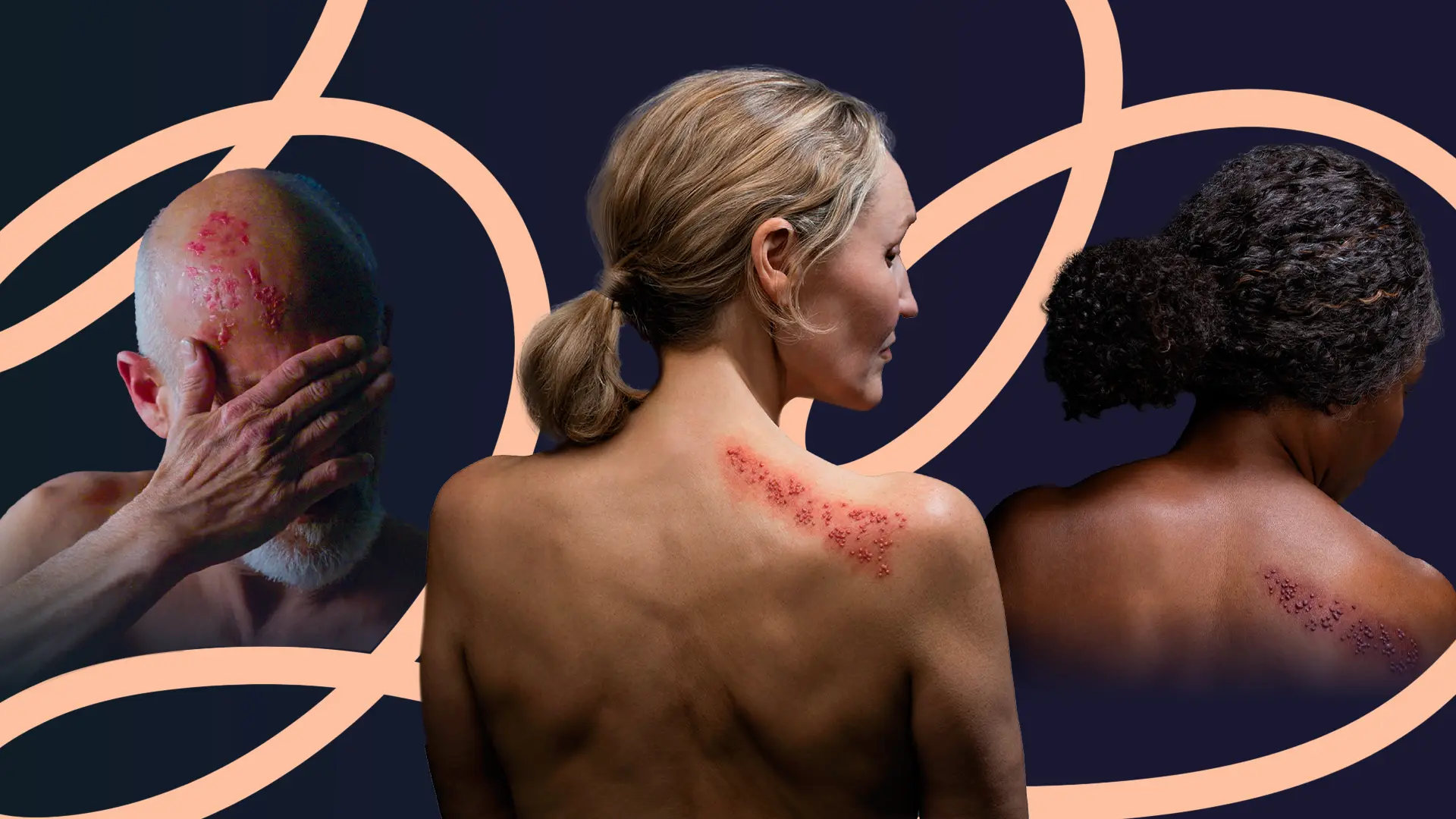 herpes zóster o culebrilla