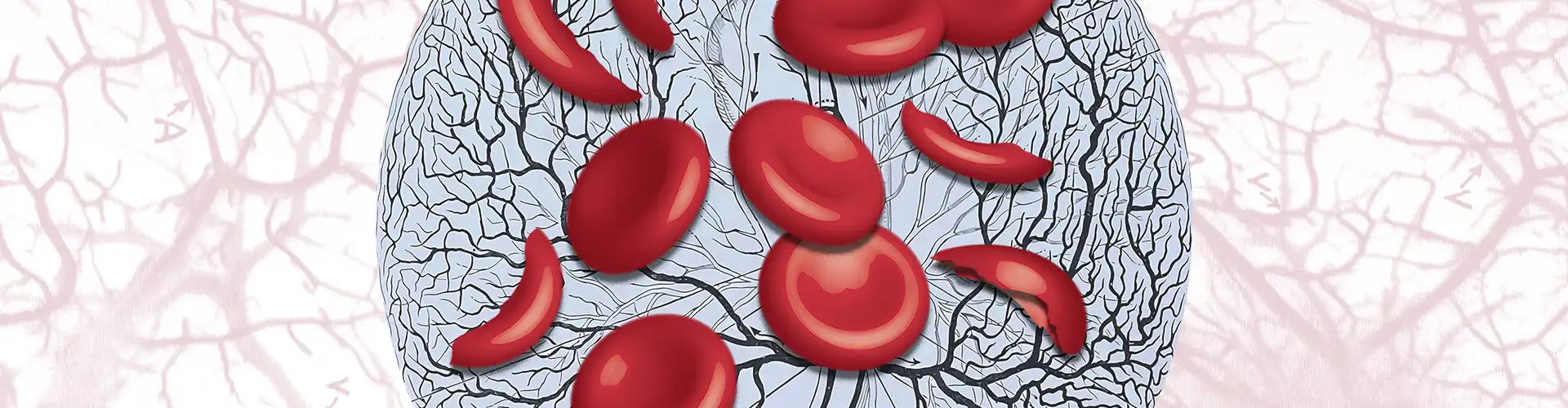 anemia falciforme