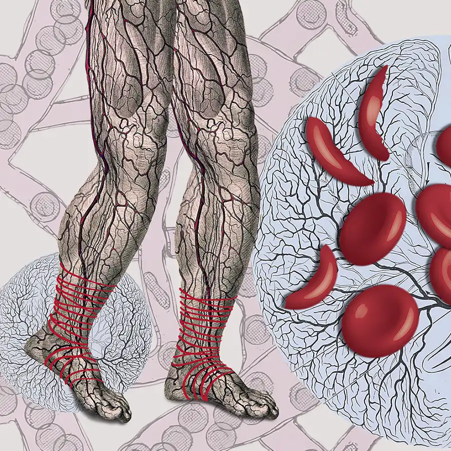 anemia falciforme