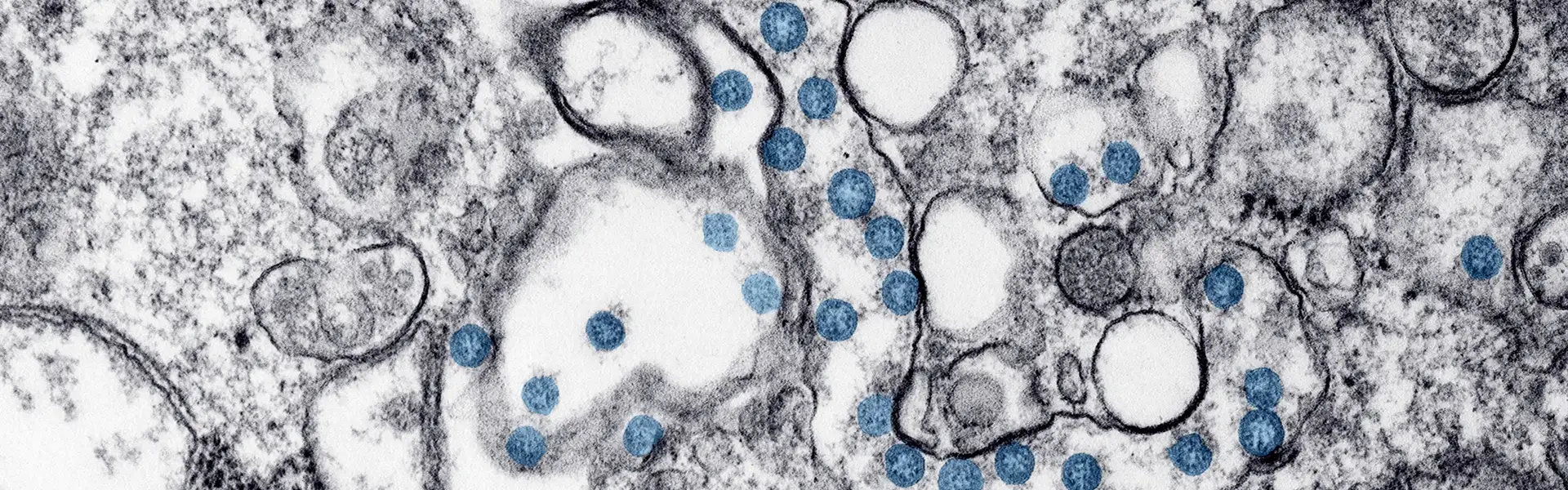 hantavirus