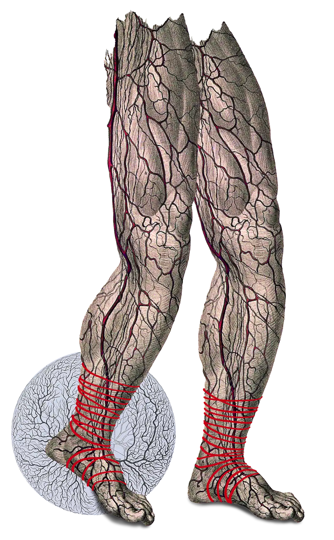 anemia falciforme