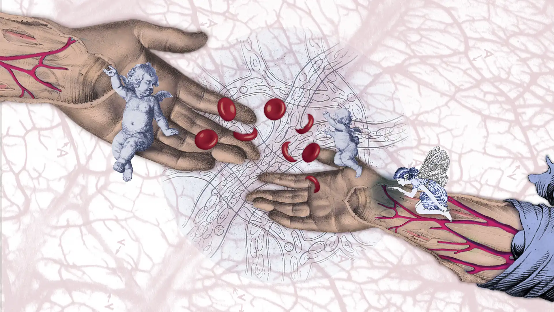 anemia falciforme
