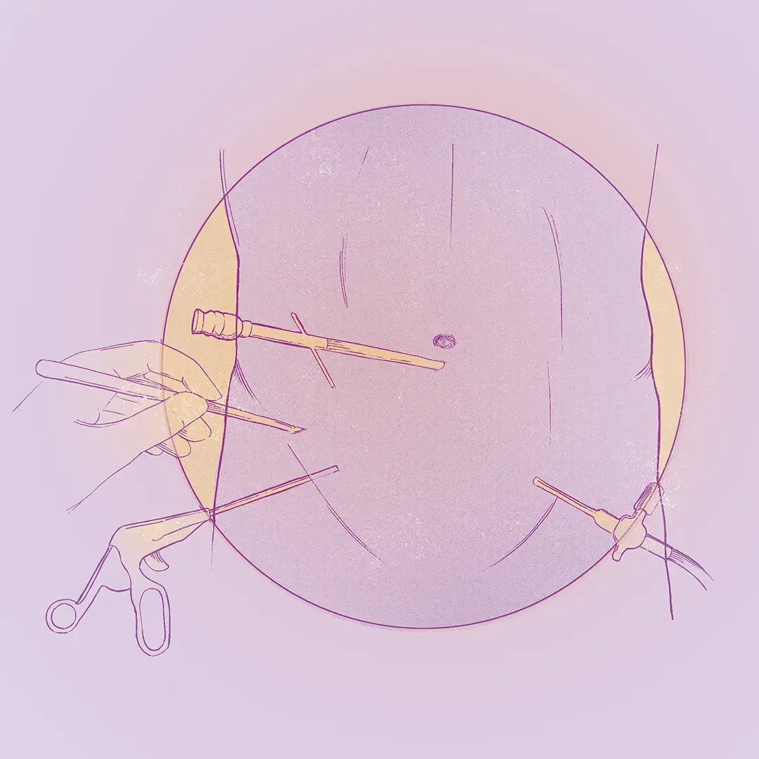 Cirugía laparoscópica