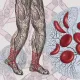anemia falciforme