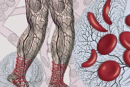 anemia falciforme