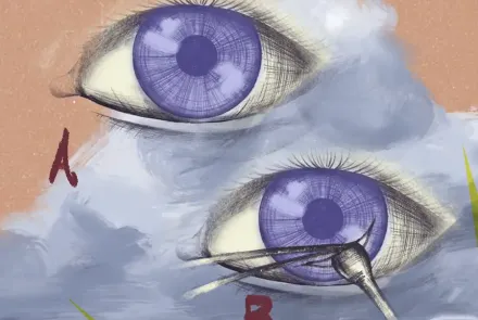 Trasplante de córnea