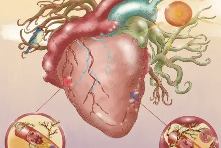 tipos de infarto